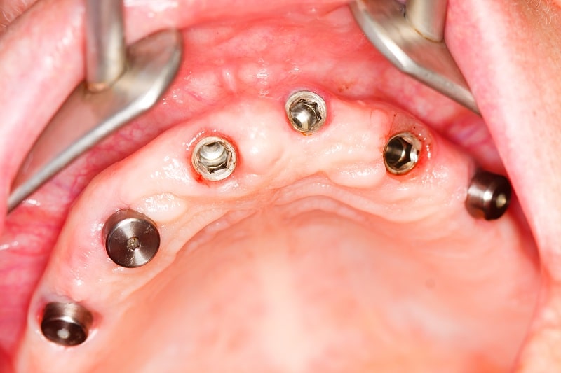 implanty zębowe rzeszów